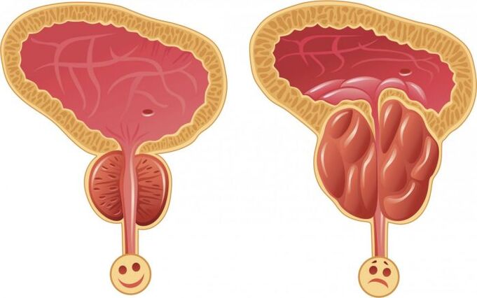 healthy and inflamed prostate with prostatitis