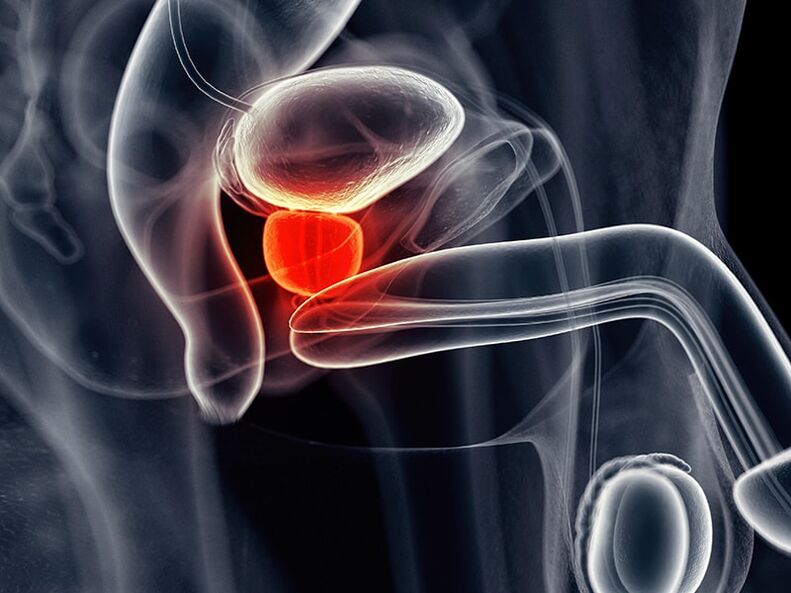 Inflammation of the prostate that accompanies chronic prostatitis